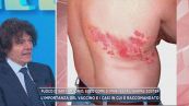 Fuoco di Sant'Antonio, ecco come si manifesta l'herpes Zoster