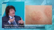 Dermatite atopica, colpiti 20% bambini e 10% adulti