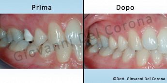 Studio Odontoiatrico Dottor Del Corona Giovanni Prima e dopo il trattamento