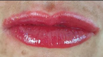 Filler labbra con acido ialuronico