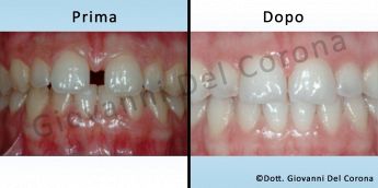 Studio Odontoiatrico Dottor Del Corona Giovanni Studio Odontoiatrico Dottor Del Corona Giovanni Prima e dopo il trattamento