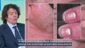 Eczema cronico della pelle, cos'è e come si cura