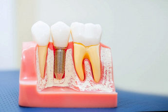 Il Sorriso Studio DentisticoCHIRURGIA ORALE E IMPLANTOLOGIA