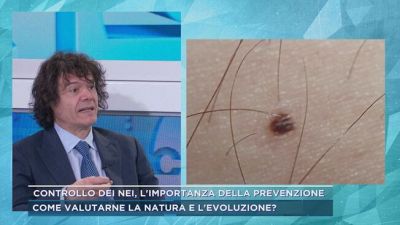 Controllo dei nei, l'importanza della prevenzione