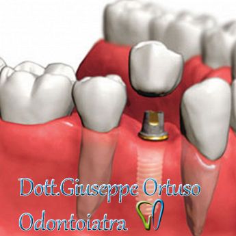 Dentista - Roma Centro - Dottor Ortuso Giuseppe IMPIANTI