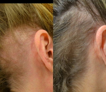 ISTITUTO TRICOLOGICO alopecia androgenica