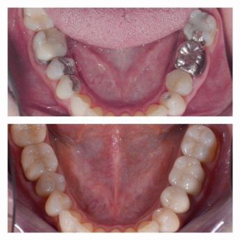 STUDIO DENTISTICO DIDENT Applicazione corone dentali, applicano corone dentali