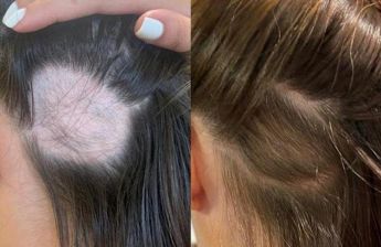 ISTITUTO TRICOLOGICO alopecia donna