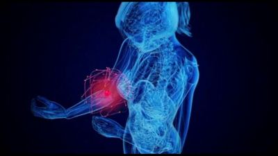 Salute e artride reumatoide: cure personalizzate per la qualità di vita