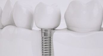 Odontobi Dental Clinic - Implantologia