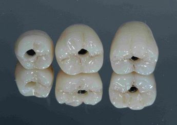 Smile-Atelier-del-sorriso-studio-dentistico-varese-corone-ceramica -impiantoprotesi